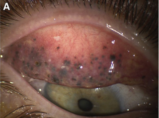 Illustration for article titled Este es el espantoso resultado de una mujer que durmió más de 25 años con maquillaje en los ojos
